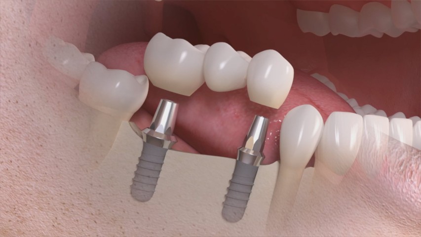 15901 Лечение , протезирование и имплантация зубов в Полтаве на выгодных условиях